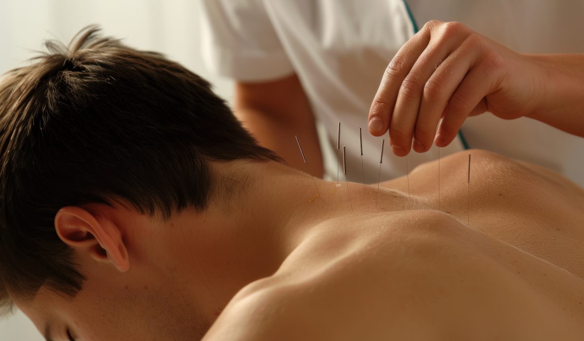 A man receiving acupuncture therapy for pain backs relief .
